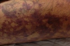 Suy đa phủ tạng sau giết mổ lợn, cách nào phòng tránh liên cầu lợn?​