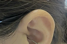 Bị người nhà va trúng khi đang lấy ráy tai, cô gái thủng màng nhĩ 