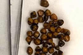 Lấy ra hơn 40 viên sỏi trong túi mật người phụ nữ 51 tuổi