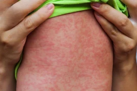 Cứu sống bệnh nhi mắc sởi biến chứng viêm cơ tim cấp