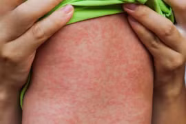 Cứu sống bệnh nhi mắc sởi biến chứng viêm cơ tim cấp