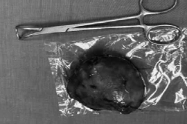 Cắt bỏ khối bướu tuyến giáp bị "bỏ quên" 40 năm cho cụ bà 81 tuổi