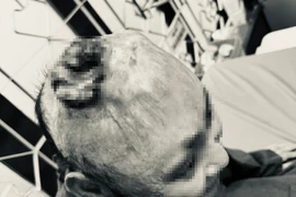 Chủ quan vết thương nhỏ trên da, người đàn ông mắc ung thư biểu mô vảy