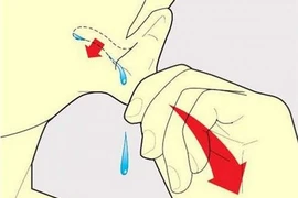 Mẹo xử trí khi bị nước vào tai an toàn, không gây nhiễm trùng