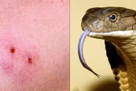 Bị rắn độc rắn, sơ cứu thế nào cho đúng?