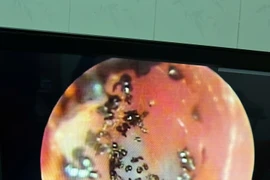 Ổ ve rận ký sinh trong tai bé gái 6 tuổi