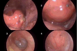 Tự lấy xương cá bị hóc, người đàn ông phù nề hạ họng, thanh quản