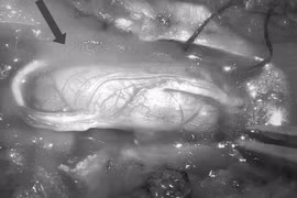 U tủy sống - nguy cơ tàn phế nếu không được điều trị kịp thời