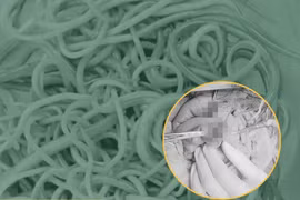 Giải phóng hơn 100 con giun trong ruột bé trai 2 tuổi