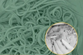 Giải phóng hơn 100 con giun trong ruột bé trai 2 tuổi