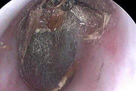 Con bướm chết trong tai người phụ nữ gây viêm, sung huyết