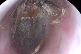 Con bướm chết trong tai người phụ nữ gây viêm, sung huyết