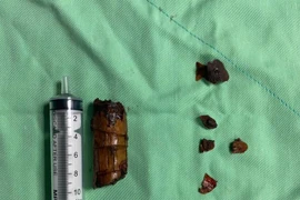 Đang dọn vườn, người đàn ông bị cành cây đâm xuyên góc hàm vào tận cổ