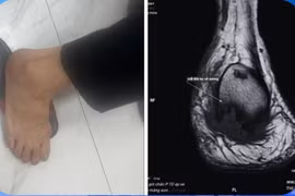 Đau gót chân uống thuốc không khỏi, đi khám phát hiện viêm xương tủy