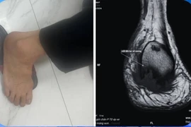 Đau gót chân uống thuốc không khỏi, đi khám phát hiện viêm xương tủy