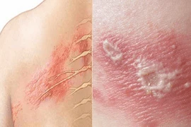 Người đàn ông 47 tuổi bị liệt mặt sau khi mắc zona thần kinh