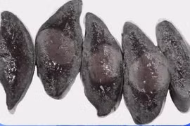 Đau bụng âm ỉ, đi khám ngỡ ngàng vì khối dị dạng hiếm gặp ở nách