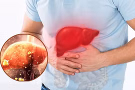 Cảnh báo 5 thói quen tàn phá gan vào mùa lạnh