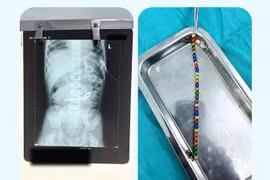 Bé trai 3 tuổi thủng ruột 8 chỗ... vì nuốt phải 31 viên nam châm