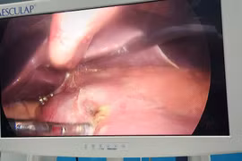 Đau bụng dữ dội, buồn nôn, đi khám phát hiện thủng dạ dày