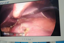 Đau bụng dữ dội, buồn nôn, đi khám phát hiện thủng dạ dày