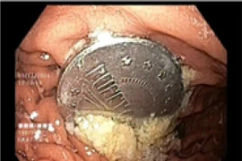 Gắp thành công đồng xu đường kính 4cm trong dạ dày bé trai 11 tuổi