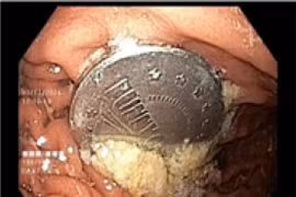 Gắp thành công đồng xu đường kính 4cm trong dạ dày bé trai 11 tuổi