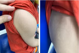 Bé trai suy tuyến thượng thận do tự ý dùng "thuốc đông y tăng cân"