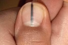 Ngón chân đen đầu, đi khám bất ngờ phát hiện ung thư tế bào hắc tố