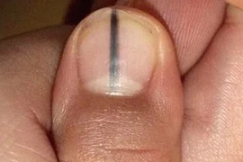 Ngón chân đen đầu, đi khám bất ngờ phát hiện ung thư tế bào hắc tố