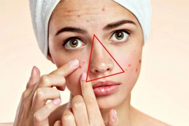 Tại sao không nên nặn mụn ở vùng “tam giác tử thần”?