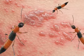 Biểu hiện viêm da tiếp xúc do kiến ba khoang gây ra