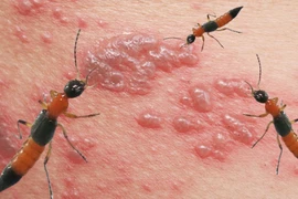 Biểu hiện viêm da tiếp xúc do kiến ba khoang gây ra