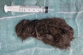 Đau bụng, khó tiêu,... đi khám phát hiện cả búi tóc trong dạ dày