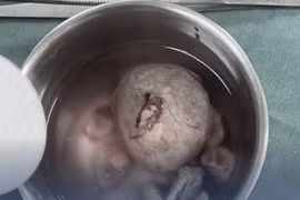 Lấy viên sỏi bàng quang "to như quả trứng gà" cho bệnh nhân 49 tuổi