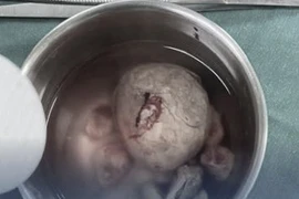 Lấy viên sỏi bàng quang "to như quả trứng gà" cho bệnh nhân 49 tuổi