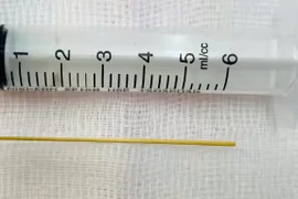 Thủng dạ dày vì vô tình nuốt phải tăm khi đang cổ vũ bóng đá