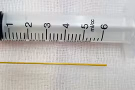 Thủng dạ dày vì vô tình nuốt phải tăm khi đang cổ vũ bóng đá