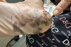 Gót chân mang vết đen lạ đi khám bất ngờ phát hiện ung thư 