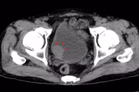 Tiểu rắt liên tục, đi khám bất ngờ phát hiện u bàng quang