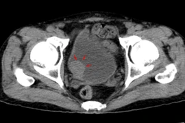 Tiểu rắt liên tục, đi khám bất ngờ phát hiện u bàng quang