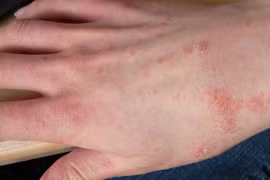 "Điểm mặt" 5 bệnh về da dễ gặp vào mùa mưa