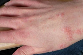 "Điểm mặt" 5 bệnh về da dễ gặp vào mùa mưa