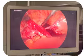 Phẫu thuật cấp cứu thành công bệnh nhân chửa ngoài tử cung vỡ 