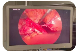 Phẫu thuật cấp cứu thành công bệnh nhân chửa ngoài tử cung vỡ 