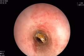 Biến chứng nguy hiểm của dị vật đường thở