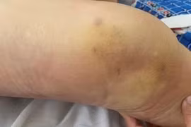 Cảnh báo những tai biến thường gặp do tự điều trị bệnh xương khớp