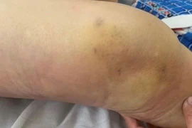 Cảnh báo những tai biến thường gặp do tự điều trị bệnh xương khớp