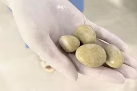 Lấy 4 viên sỏi to như "quả trứng" trong bàng quang người đàn ông 40 tuổi