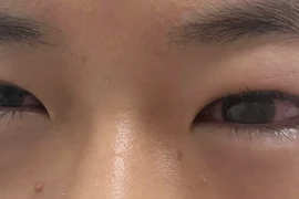 Bỏng giác mạc do gội đầu bằng nước hạt na: Lời cảnh tỉnh cho cha mẹ